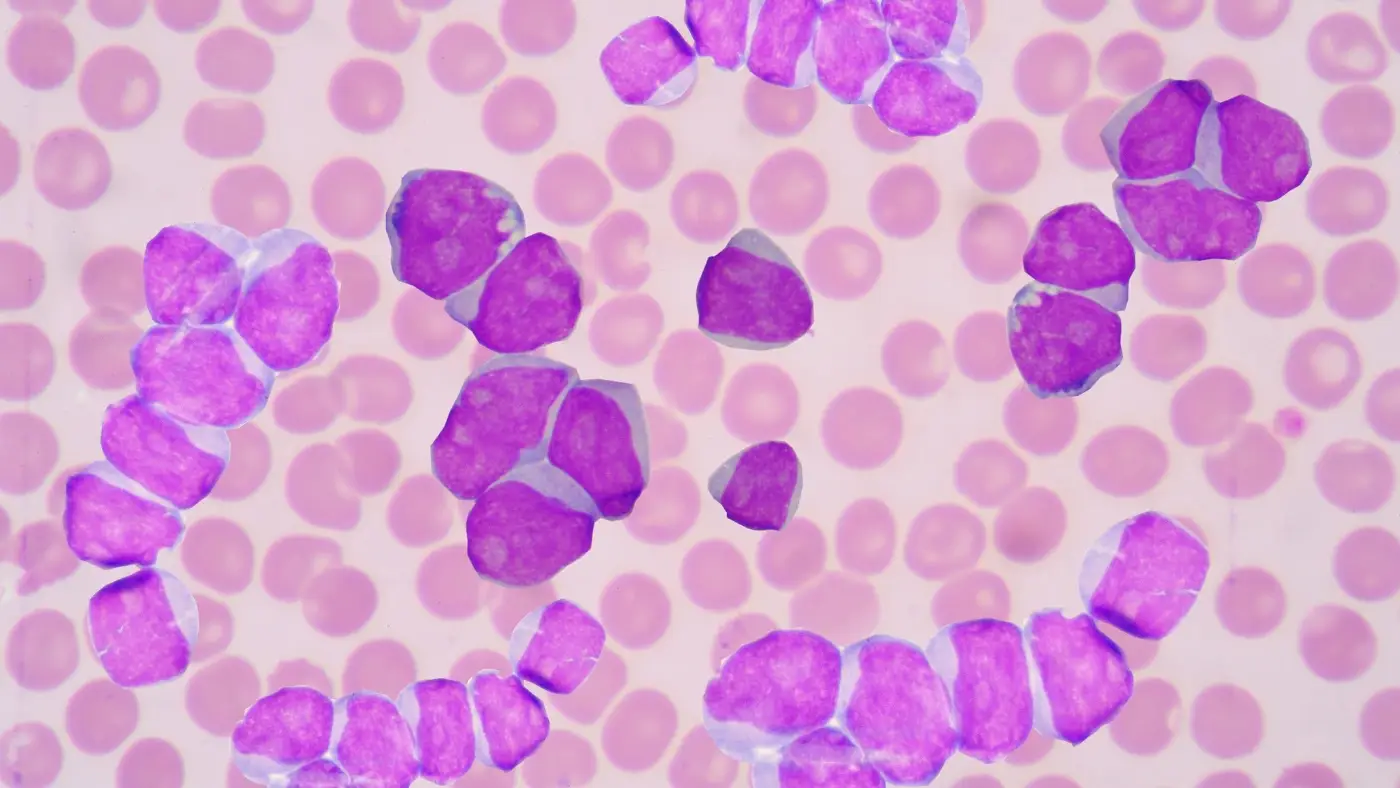 Combination Therapy (Revuforj + Venclexta + Inqovi)